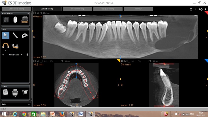 Jaw Cyst Tumor Surgery Fms Dental Hospital 1062