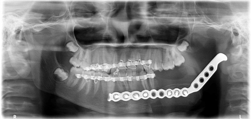 Jaw Cyst Tumor Surgery Fms Dental Hospital 7890